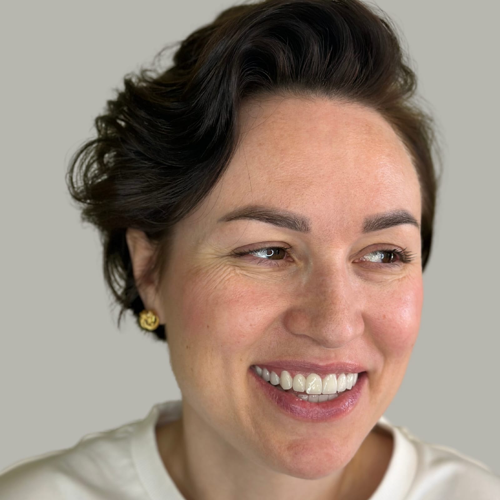 Smile Transformation 4